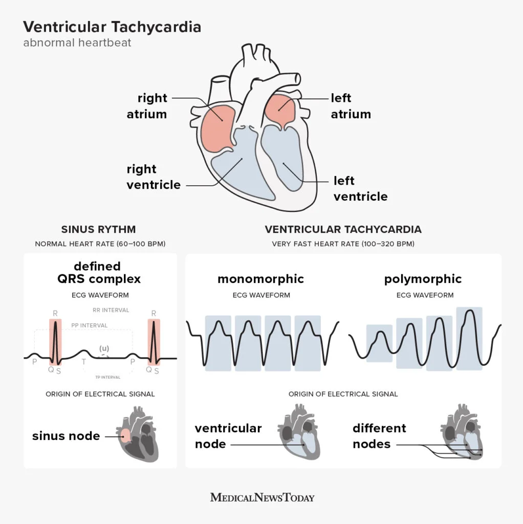 Monomorphic Ventricular Tachycardia